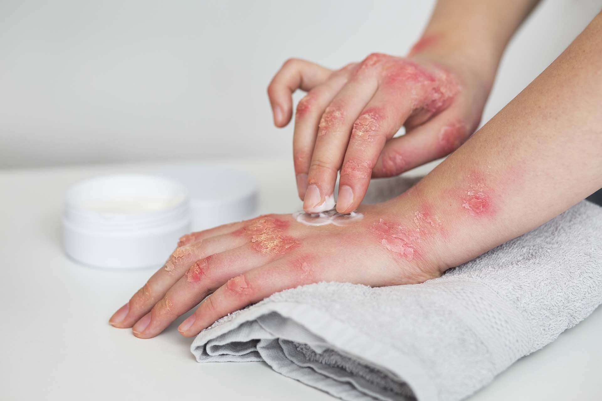 Psoriasi e primavera